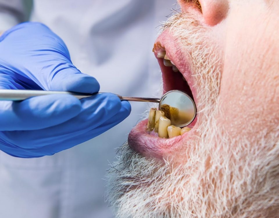 Meth Mouth: The Effects of Long-Term Meth Use on Oral Health
