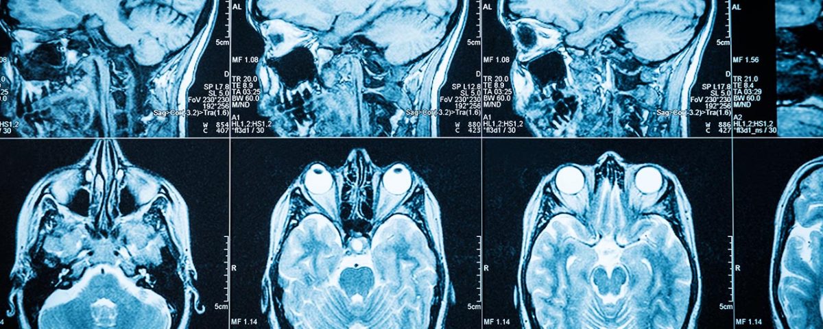 Chronic Traumatic Encephalopathy and Drug Abuse
