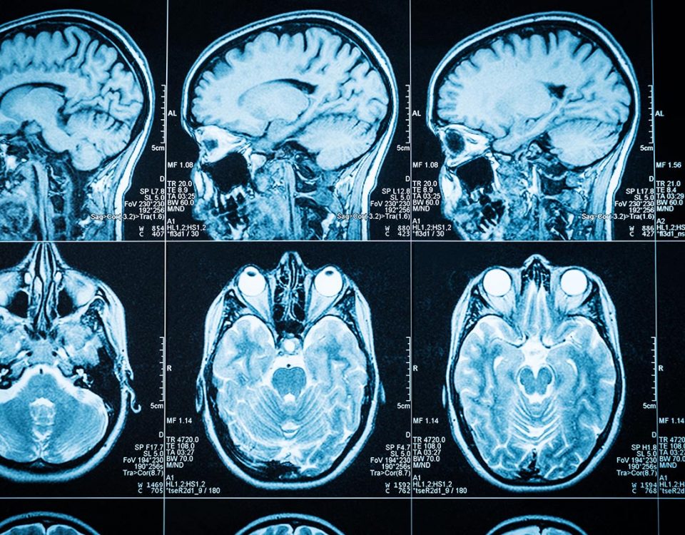 Chronic Traumatic Encephalopathy and Drug Abuse