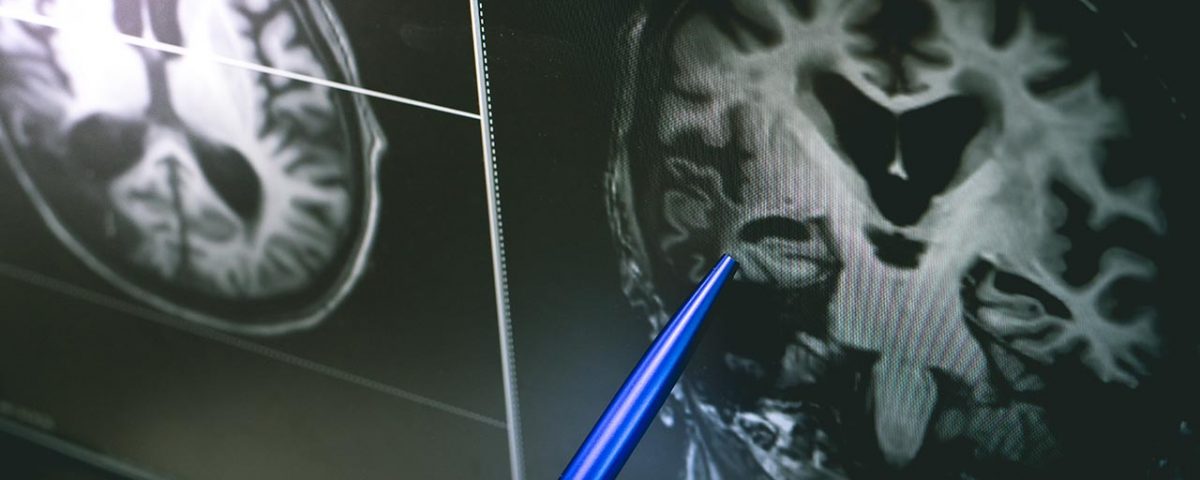 How Drug Abuse Affects White Matter in the Brain