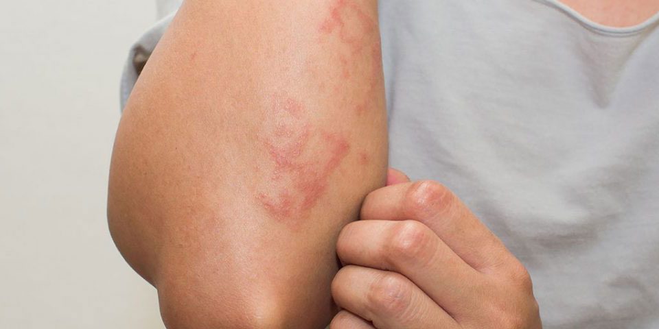 Drug-Induced Skin Disorders