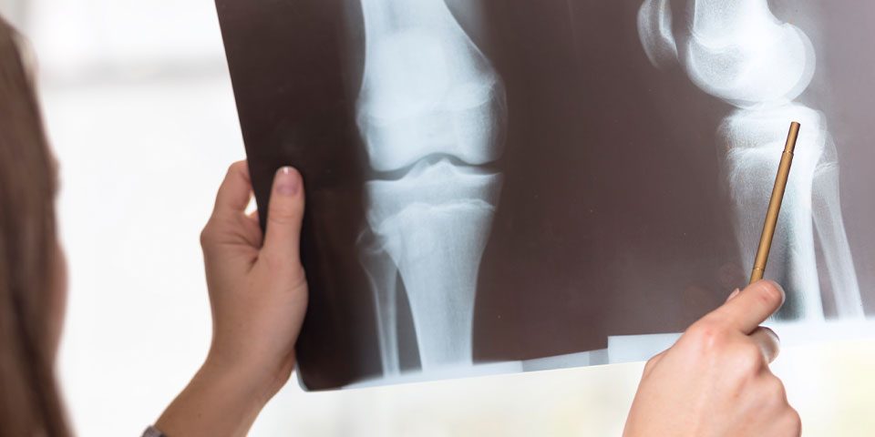 How Drugs Affect Your Bones