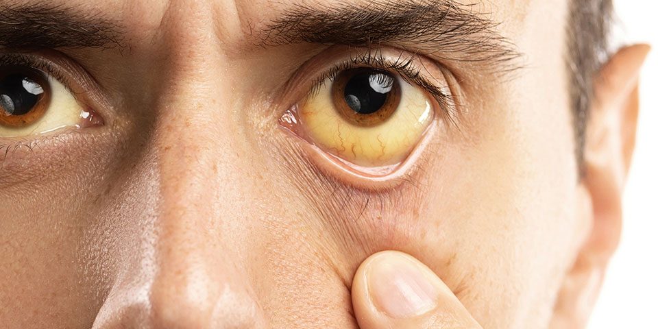 How Alcohol Affects The Eyes