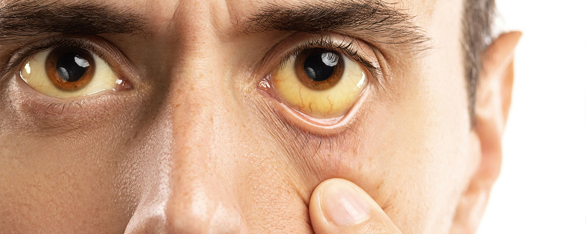 How Alcohol Affects The Eyes