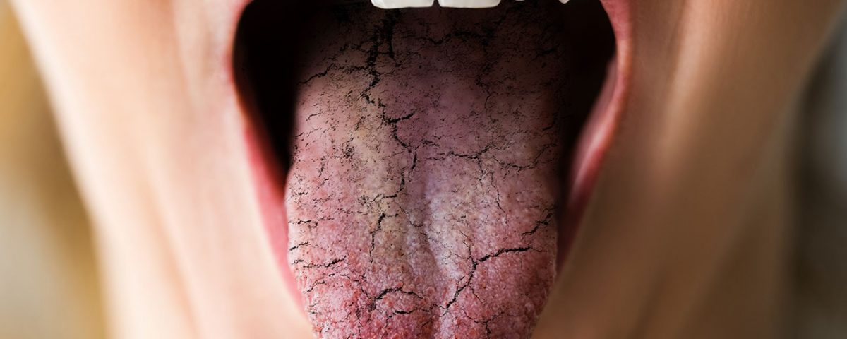 Do Opioids Cause Dry Mouth?