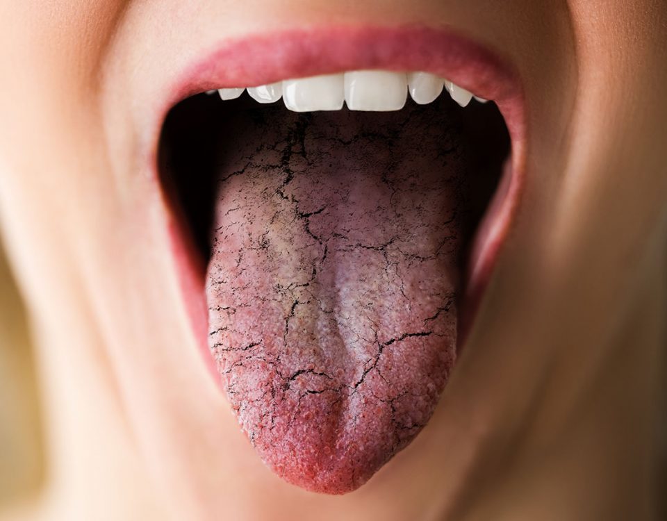 Do Opioids Cause Dry Mouth?