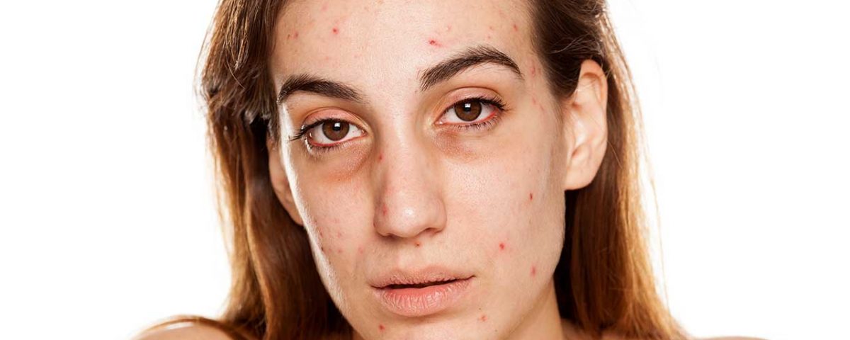 Cocaine Skin Problems
