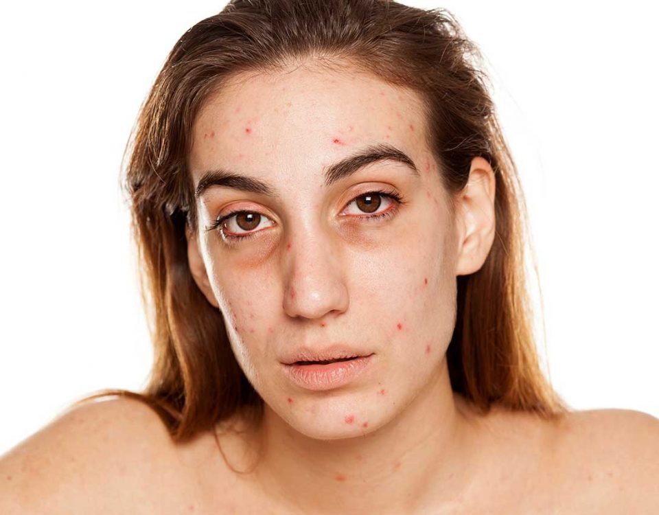 Cocaine Skin Problems