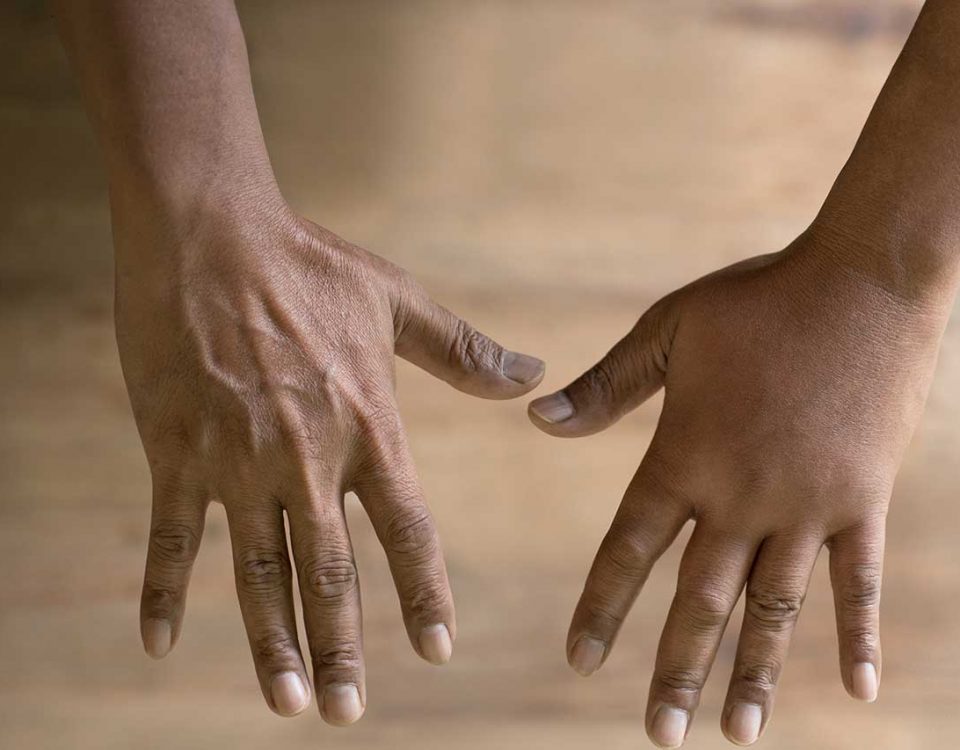 Puffy Hand Syndrome and Drug Abuse
