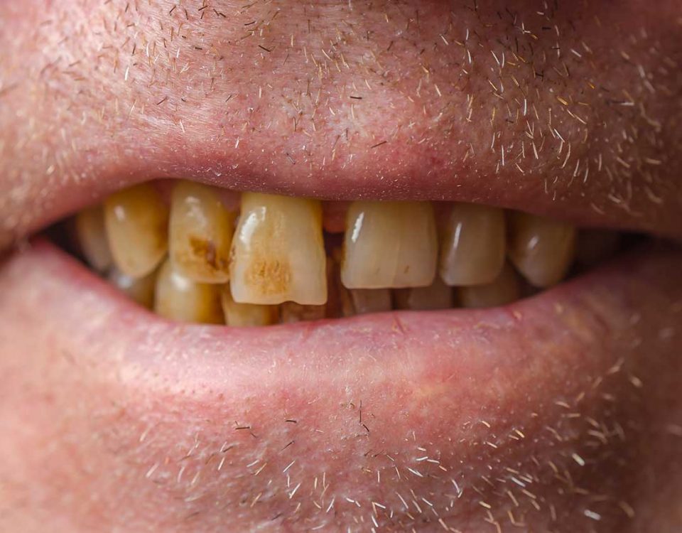 Cocaine’s Effects on Teeth