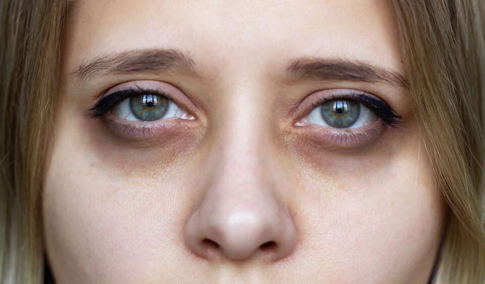 dark circles alcohol